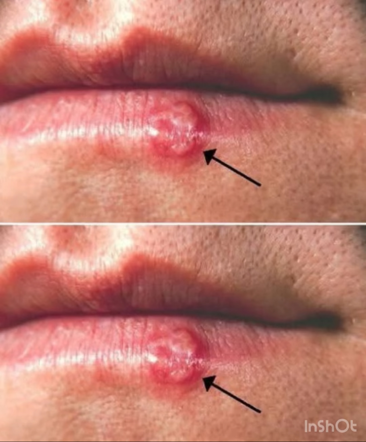 Cold Sores: What You Need to Know About Managing and Preventing Them