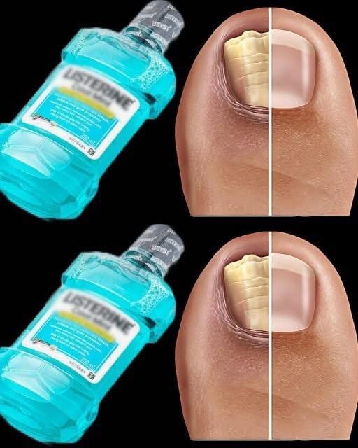 Say Goodbye To Nail Fungus With This Simple Home Remedy