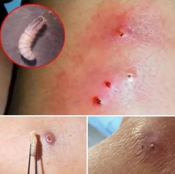 Larvae Found In Young Woman’s Body… How Did They Get There? (The Answer Will Horrify You)
